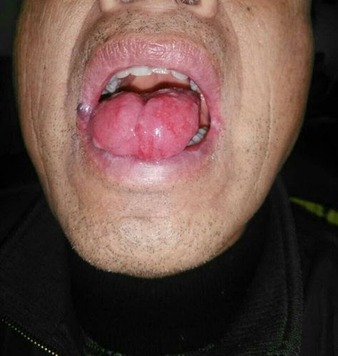2025新奥资料正版大全和舌根和牙龈被缝一起与舌根和牙龈被缝一起怎么办